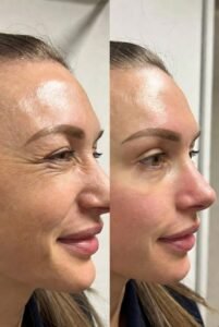 Botox in Islamabad – Botox for Under-Eye Wrinkles: Treatments and Benefits