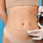 Why the Best VASER Liposuction Surgeon in Dubai Matters for Your Results