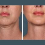 Best Plastic Surgeons in Dubai Enhancing Results with PRP Treatment