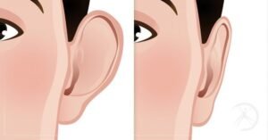 Ear Reshaping in Islamabad: Correct Protruding and Asymmetrical Ears