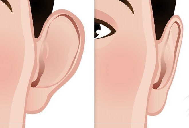 Ear Reshaping in Islamabad: Correct Protruding and Asymmetrical Ears
