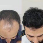 Hair Transplant in Islamabad: Regain Your Natural Hair