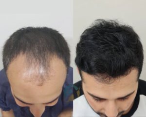Hair Transplant in Islamabad: Regain Your Natural Hair