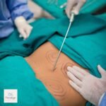Liposuction in Islamabad – Transform Your Body with Precision