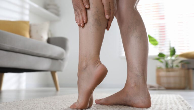 Spider Vein Treatment in Manchester – Restore Smooth Legs