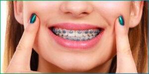 Dental Implant Near Me | Get Expert Dental Implant Treatment